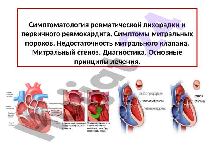 Симптоматология ревматической лихорадки и ревмокардита