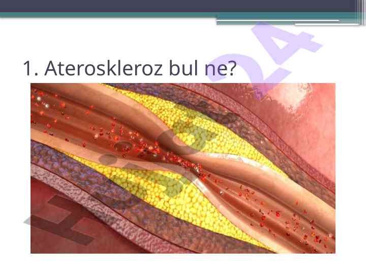 Ateroskleroz haqqida muhim ma'lumotlar