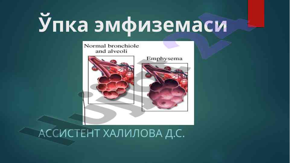 Ўпка эмфиземаси ҳақида аниқ тушунчалар