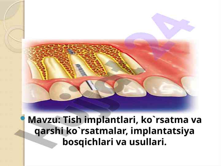 Tish implantlari: ko`rsatma va qarshi ko`rsatmalar