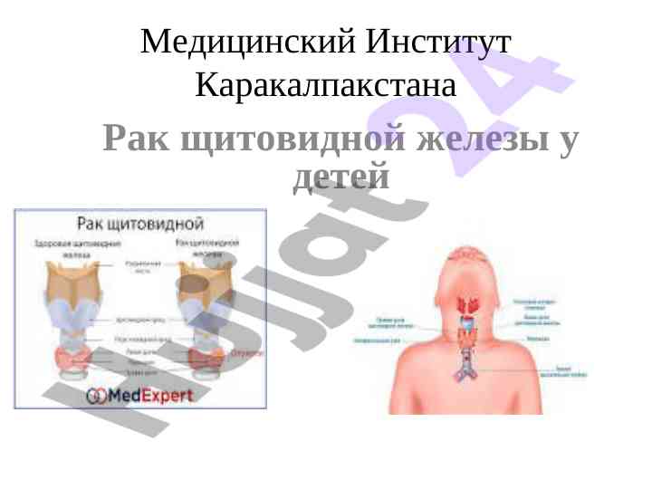 Рак щитовидной железы у детей: частота и характеристика
