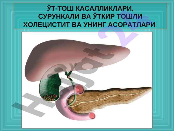 Ўт тош касалликлари: сурункали ва ўткир холестерит