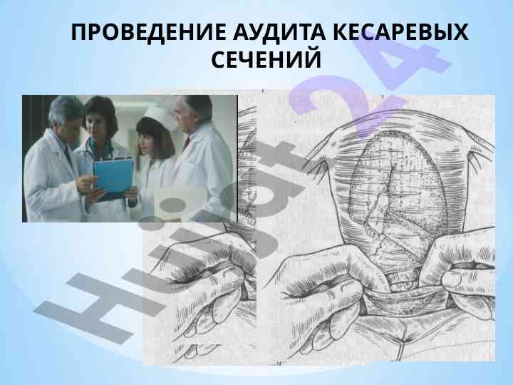 Аудит кесаревых сечений с использованием классификации robson