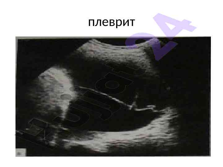 Kosto-diafragmal plevrit va uning turlari