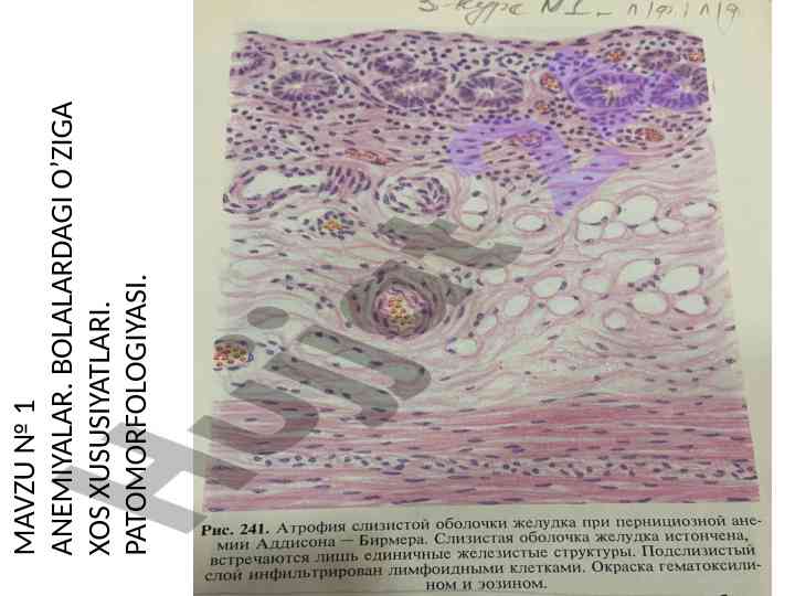 Anemiyalar bo'yicha tibbiy mavzular