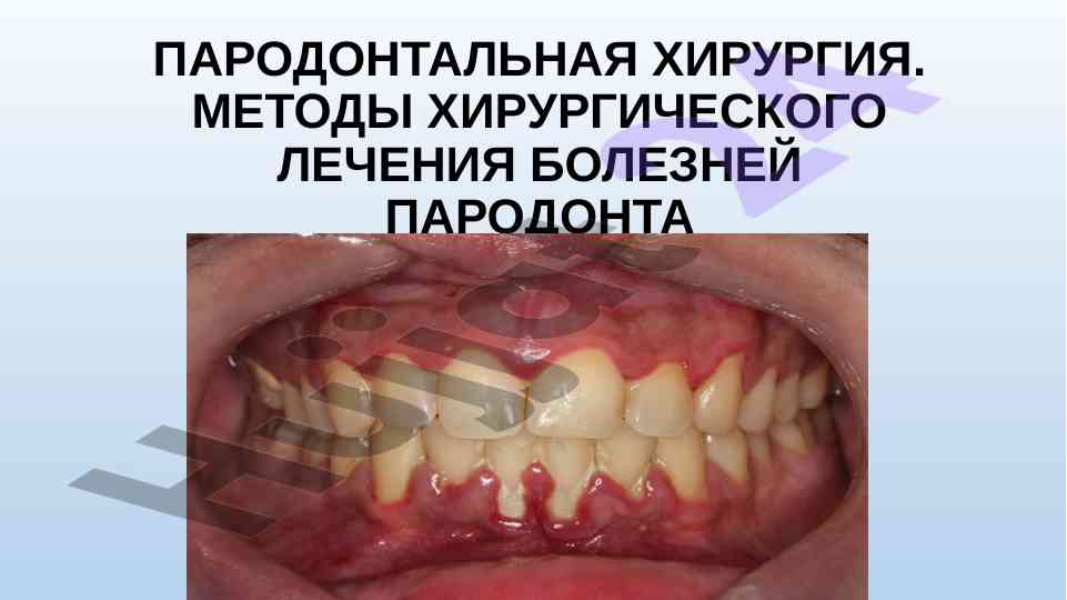 Методы хирургического лечения болезней пародонта