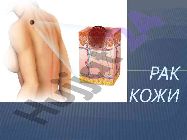 Рак кожи: эпидемиология и этиология