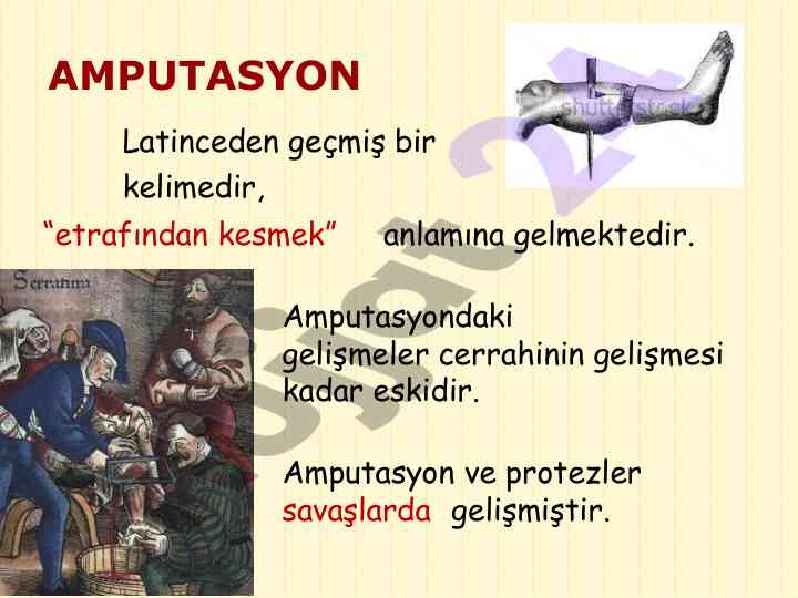 Amputasyon ve protezler üzerine gelişmeler