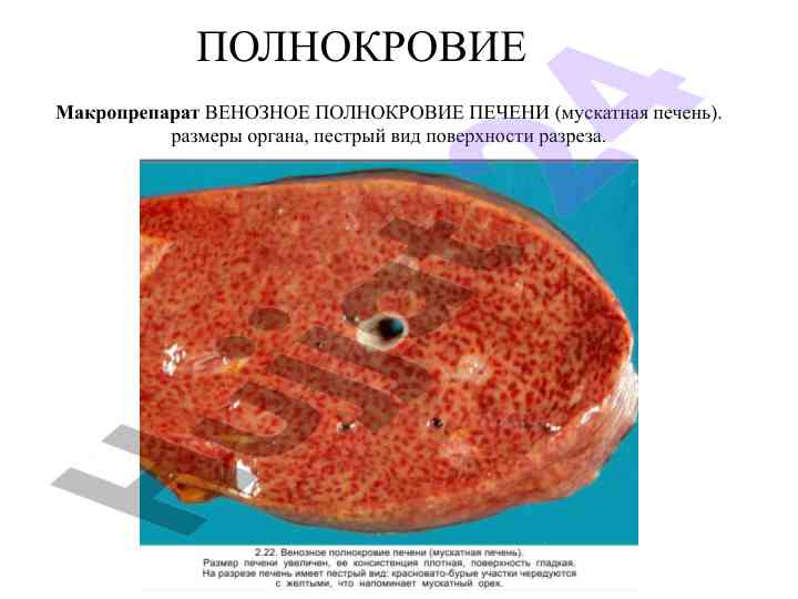 Venoznoe polnokrovie pecheni i legkih