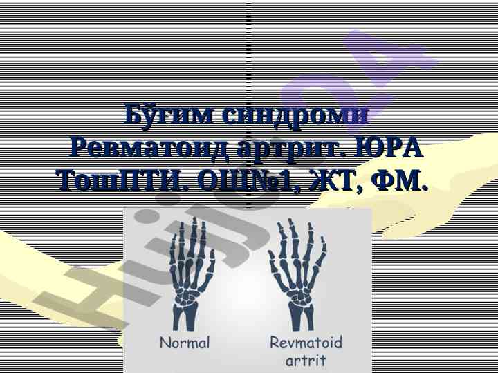 Бўғим синдроми ва ревматоид артрит ташхиси