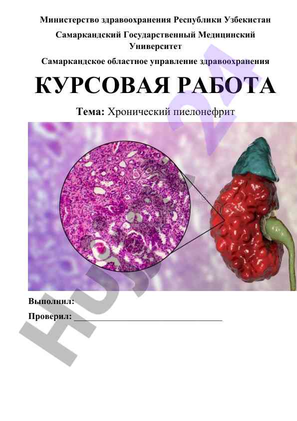 Xronik pielonefrit tahlili va davolanish usullari