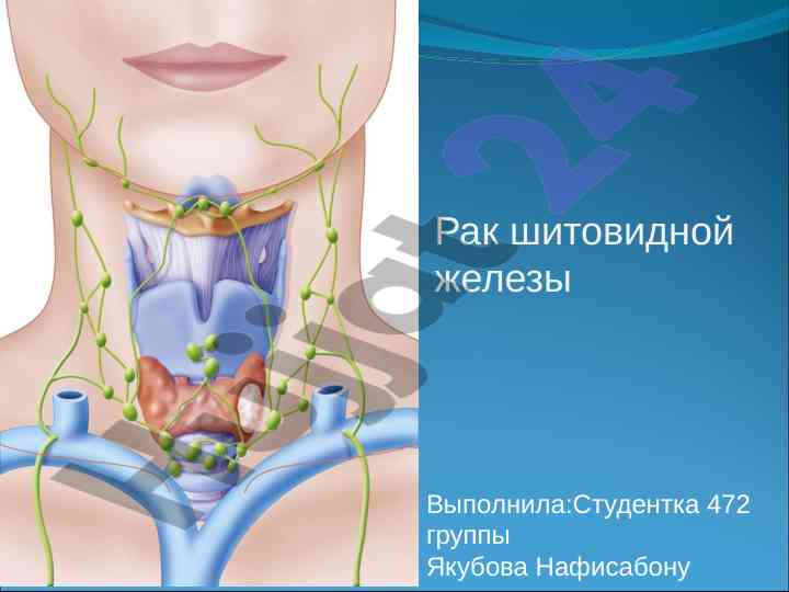 Анализ рака щитовидной железы и факторы риска