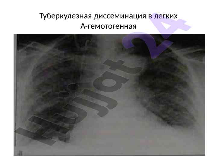 Туберкулезинг тараққиёти ва кўрсатиш синфлари