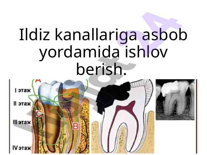 Ildiz kanalining tozalash va kengaytirish usullari