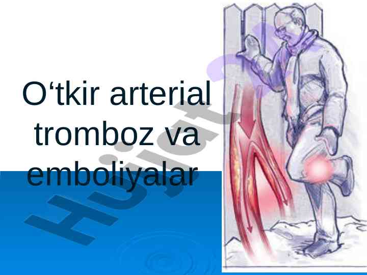 O‘tkir arterial tromboz va emboliya to‘g‘risida ma’lumot