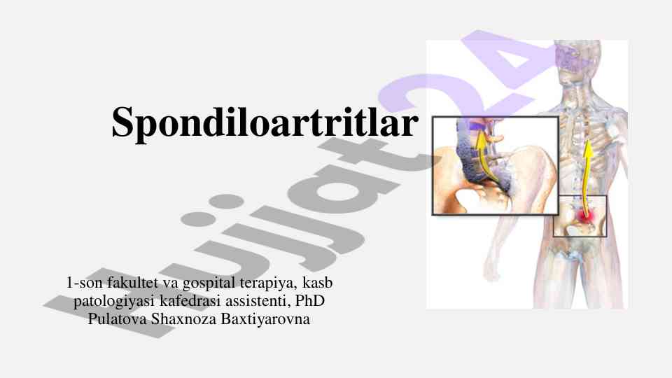 Spondiloartritlar tarixi va umumiy belgilari