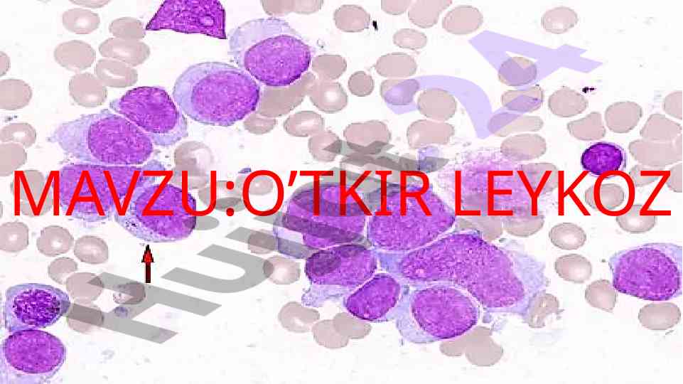 O’tkir leykoz leykemiya: belgilari va ta’siri