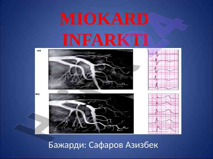 Mio kard infarkti va uning etio logiyasi