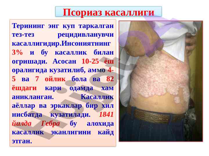 Psoriaz kasalligi va uning etiopatogenezi