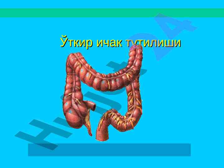 Ичак тутилишининг классификацияси ва сабаблари