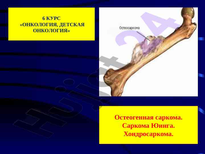 Остеогенная саркома и другие опухоли костей