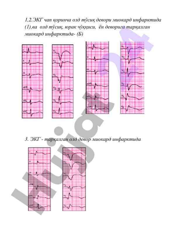 Elektrokardiografik o‘zgarishlar miokard infarktida