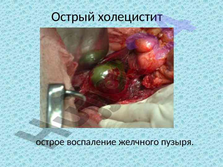 Острый холецистит и желчный проток анатомия