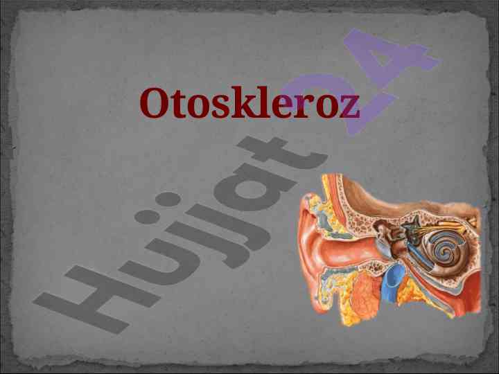 Otoskleroz kasalligining klinik belgilari