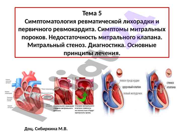 Симптоматология ревматической лихорадки и ревмокардита