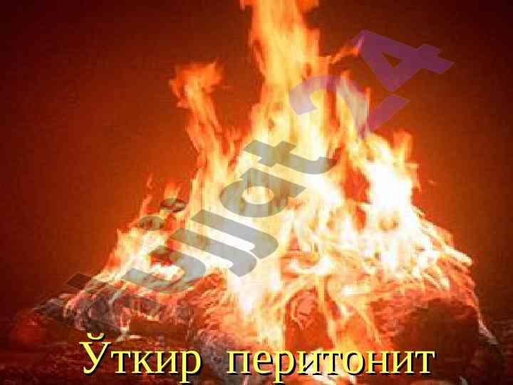 Ўткир перитонит эпидемиологияси таҳлили