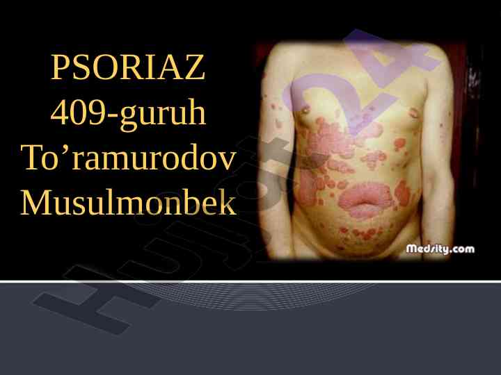 Psoriaz: tahlil va klinik rasm