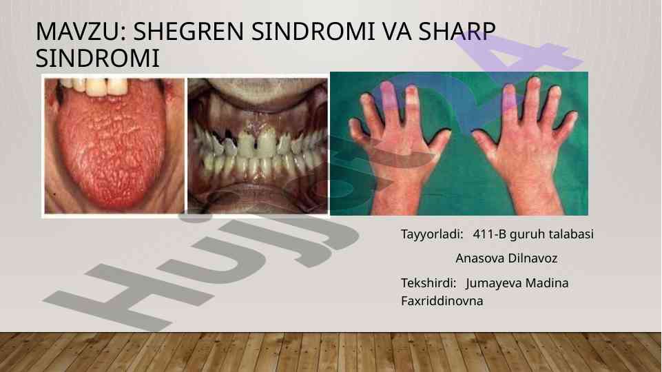 Shegren sindromi tahlili va uning ta'sirlari