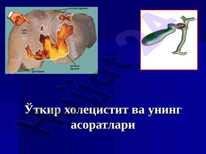 Ўткир холецистит ва асоратлари таснифи