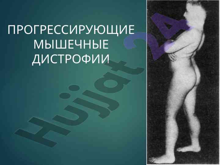 Прогрессирующие мышечные дистрофии и их классификация