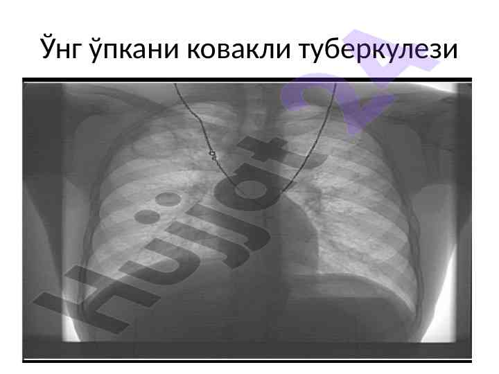 Kovakli tuberkulez tahlili va davolash jarayoni
