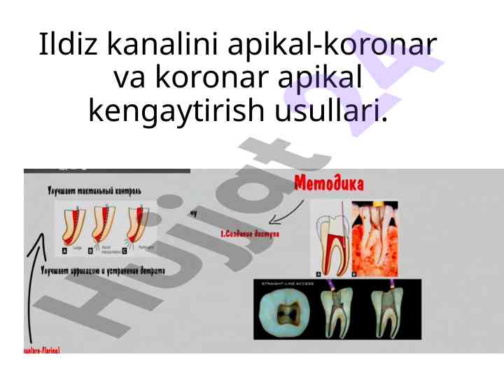 Ildiz kanalini apikal-koronar usullar bilan kengaytirish