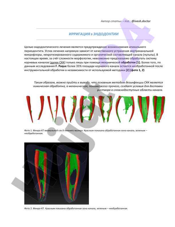 Irregatsiya v endodontii