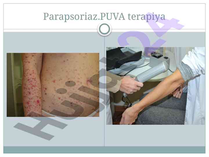 Parapsoriaz va puva terapiya haqida tadqiqot