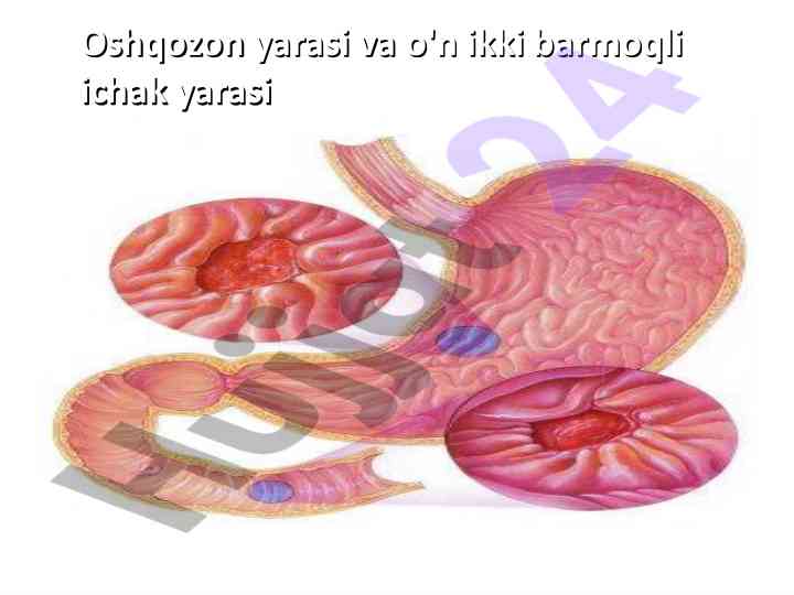 Oshqozon yarasi va o'n ikki barmoqli ichak yarasi ta'rifi