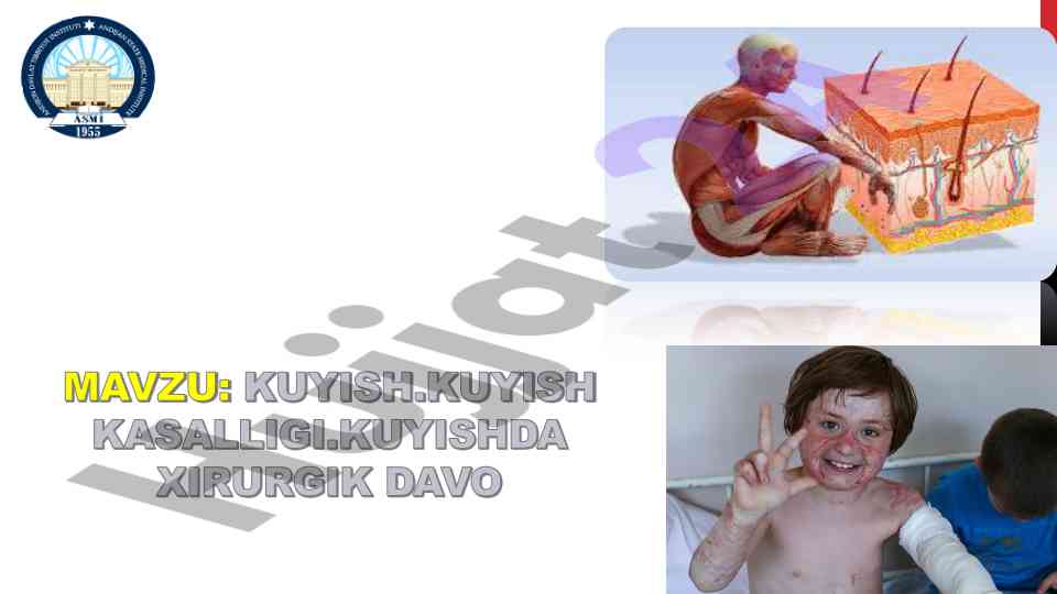 Куйиш жараҳати статистикаси ва ривожланиш