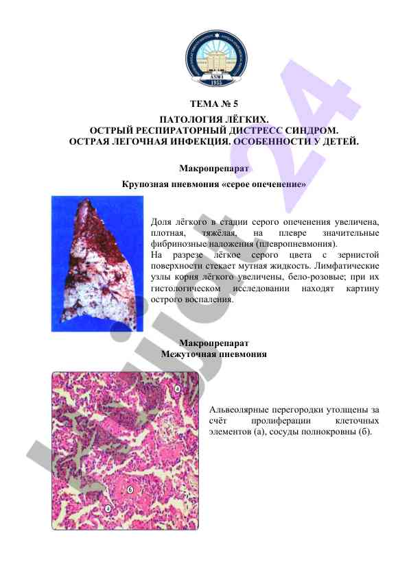 Patologiya lёgkiy: ostry respiratorny distress sindrom