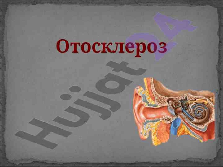 Отосклероз: дистрофическое заболевание уха