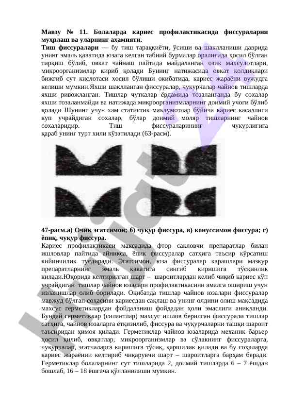 Болаларда кариес профилактикасида фиссураларни муҳрлаш