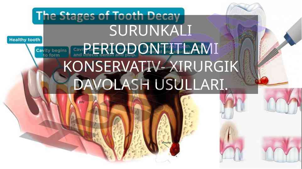 Konservativ-xirurgik davolash usullari periodontit