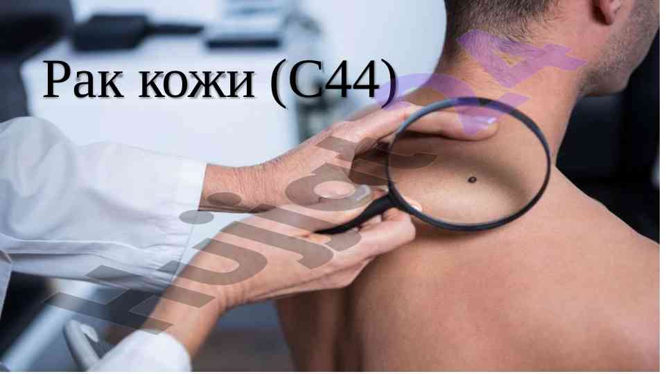 Базальноклеточный рак кожи: структура и особенности