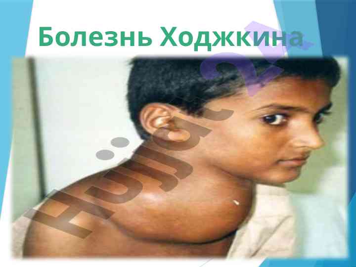Bolenz xodzhkina: limfogranulomatoz mavzusi