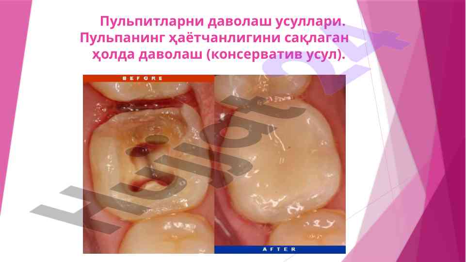 Пульпитларни биологик даволаш усуллари кўрсатмалари