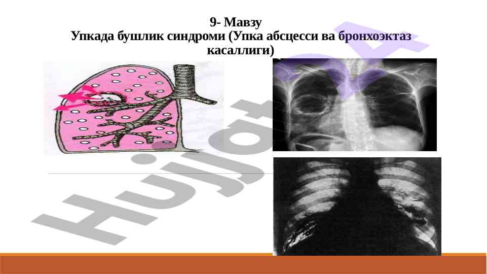 Упкада бушлик sindromi: тедқиқот ва аралашувлар