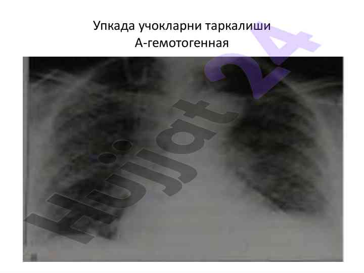 Tug'diruvchi tuberkulezning tarqalishi mavzusi