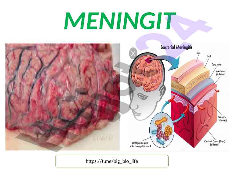 Meningit va ensefalit bo‘yicha rasmlar to‘plami